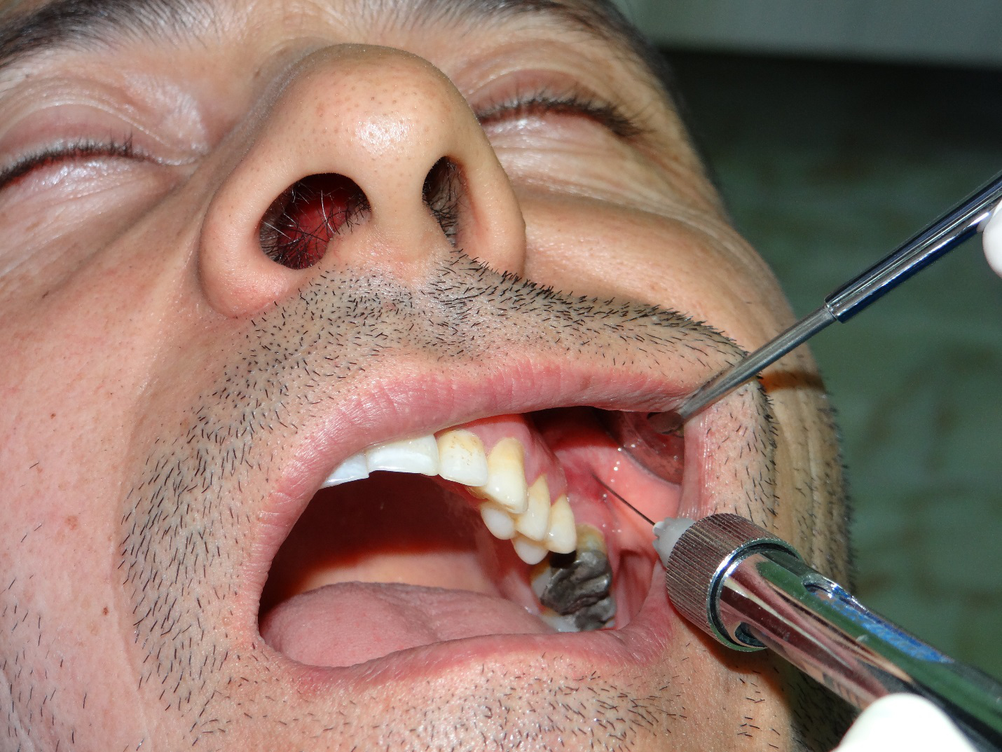 روش بی حسی لب فوقانی با بلاک عصبی داخل دهانی
