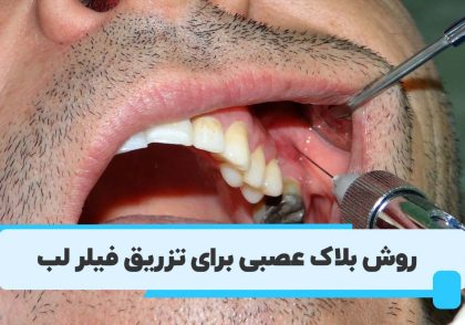 روش بلاک عصبی لب برای تزریق فیلر