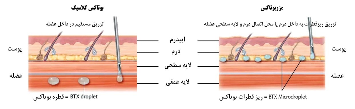 شکل تفاوت بوتاکس و میکروبوتاکس