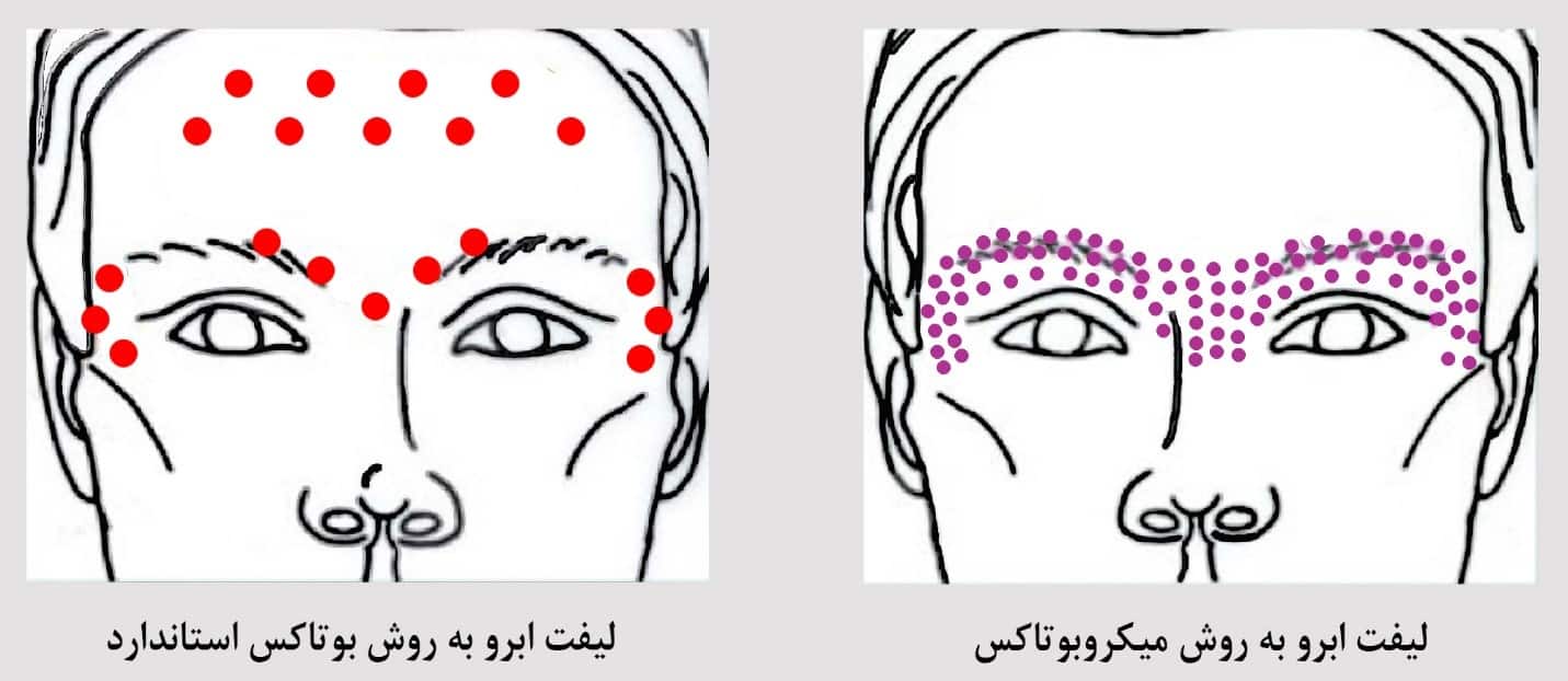 تفاوت لیفت ابرو در روش بوتاکس کلاسیک و میکروبوتاکس