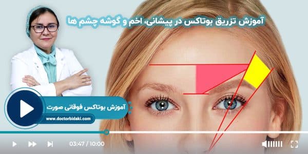 آموزش تزریق بوتاکس پیشانی