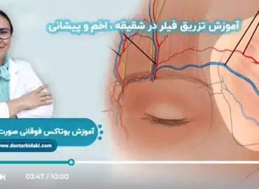 آموزش فیلر شقیقه