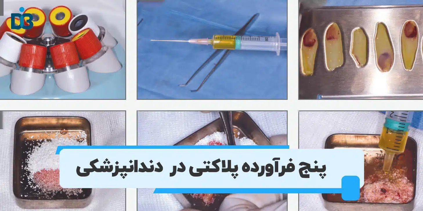 فرآورده پلاکتی در درمان های دندانپزشکی