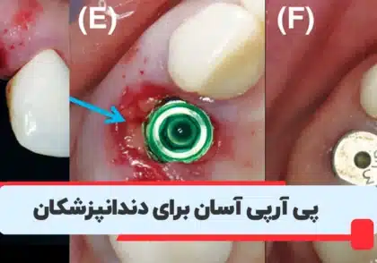 آموزش پی آر پی و پی آر اف در دندانپزشکی