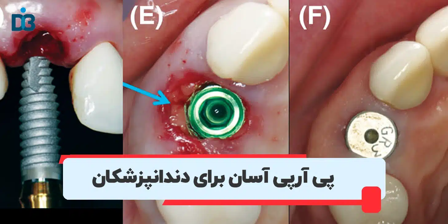 آموزش پی آر پی و پی آر اف در دندانپزشکی
