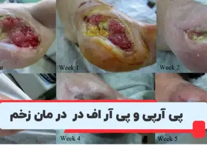 پی‌ آر پی و پی‌ آر اف در درمان زخم