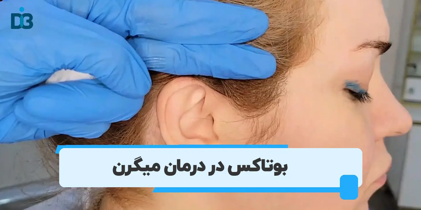 بوتاکس میگرن