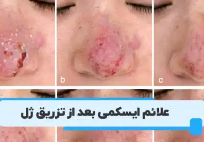 علائم ایسکمی بعد از تزریق ژل