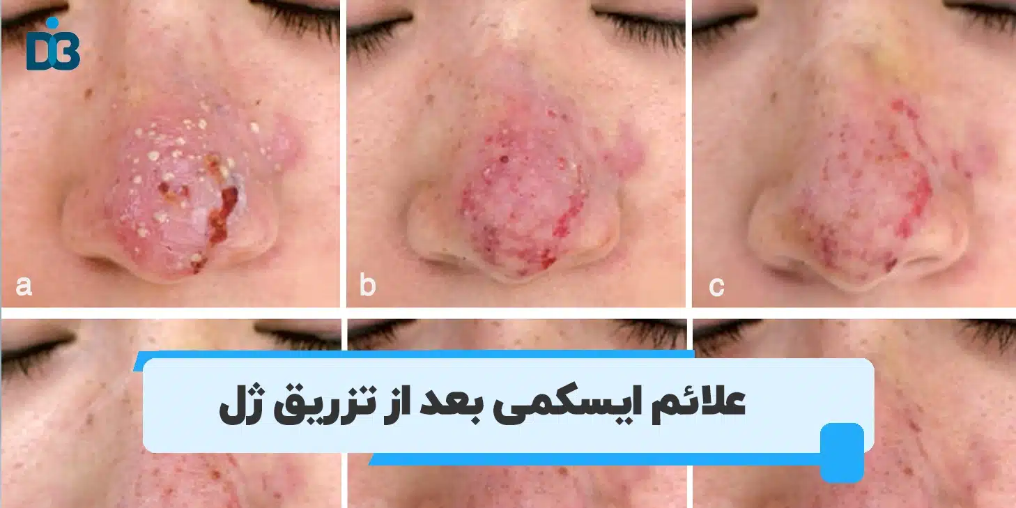 علائم ایسکمی بعد از تزریق ژل