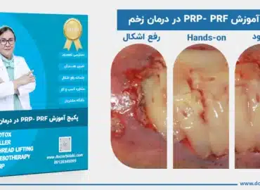 آموزش پی آرپی و پی آراف در درمان زخم
